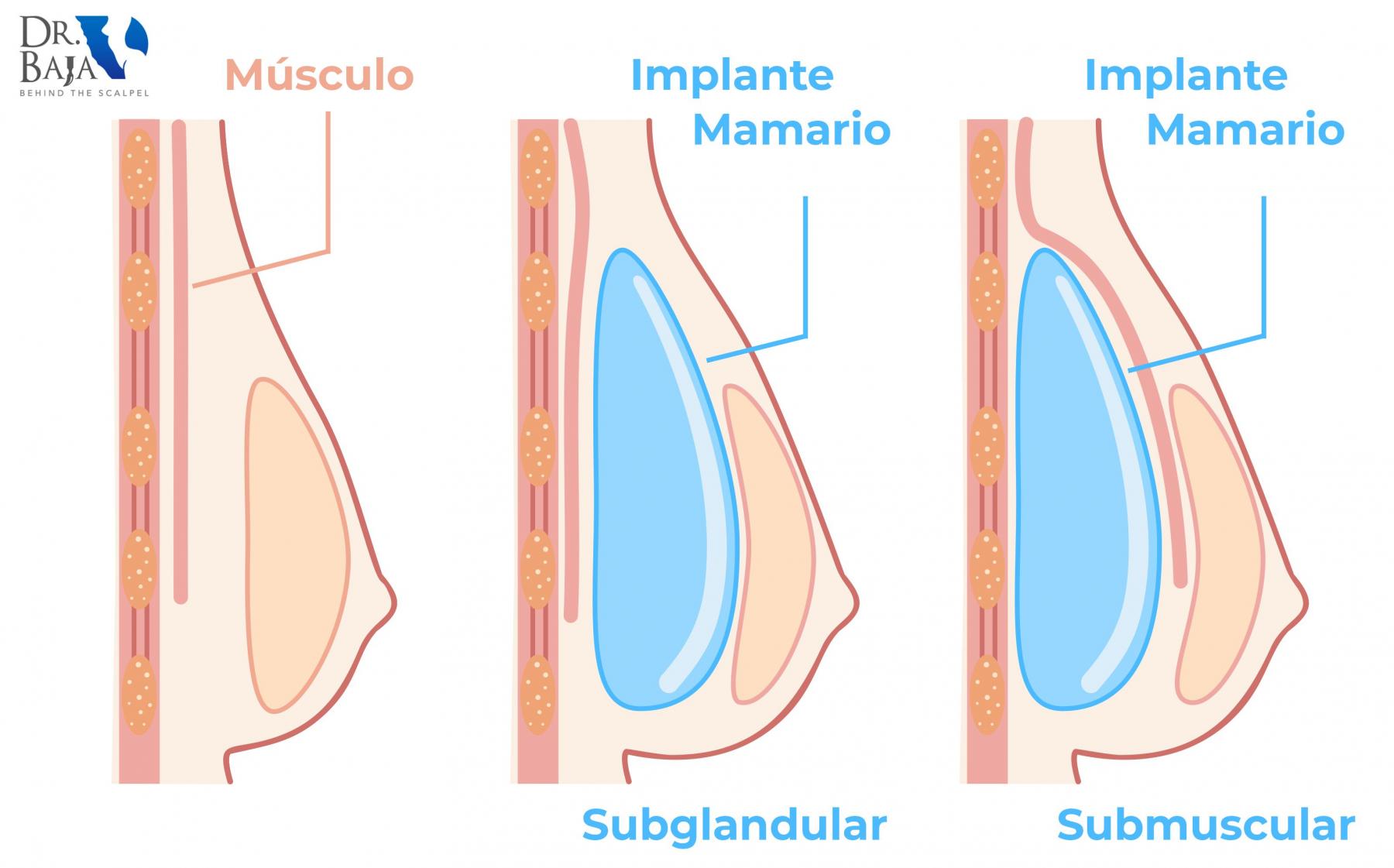 Colocación de implante